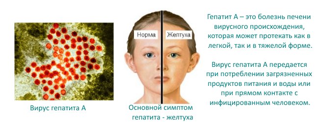 Гепатит А у ребенка